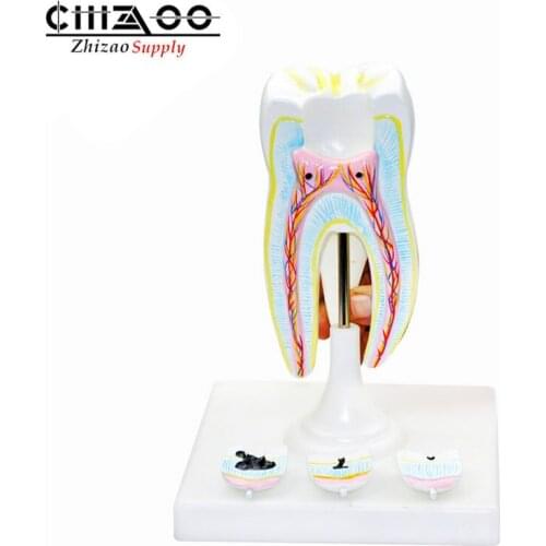 Dental molars with tooth decay model dental caries model