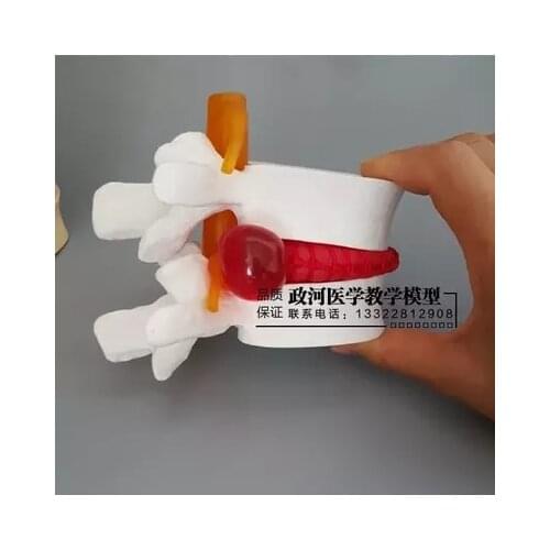 Human Lumbar Disc Herniation Model Demonstration Model of Lumbar Vertebral Model Orthopedic Model