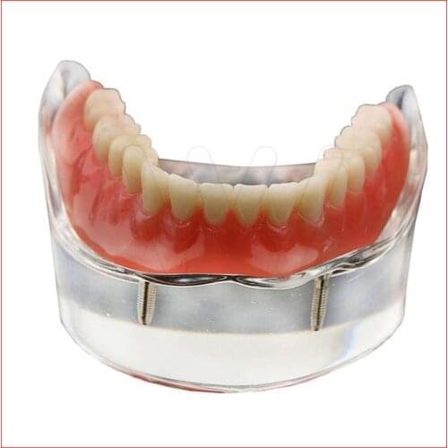 1Pc Dental Teeth Study Model Overdenture Inferior 4 Implant Demo Model