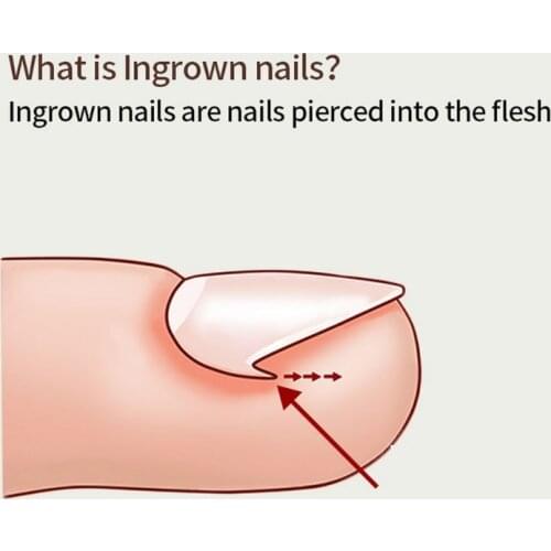 10pcs/set Ingrown Toenail Correcting Tool Pain Care Ingrowing Nail Corrector Used for Home