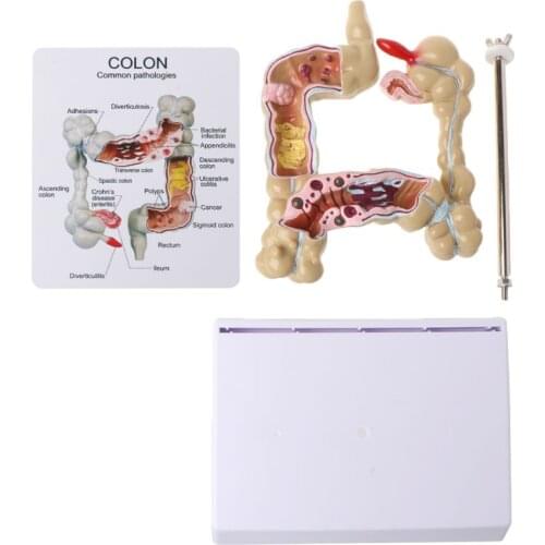 Human Colorectal Lesion Model Pathological Anatomy Colon Diseases Intestine Medical Teaching Learning Tool 19QA
