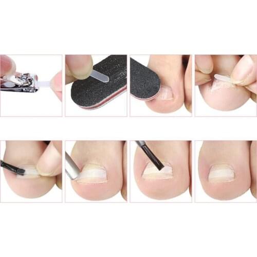 Ingrown Toenail Corrector Stickers Elastic Tape W/Pusher Nail