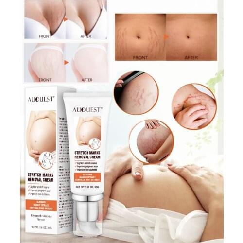 Stretch Marks Remove Skin Care Treatment Repair Anti-Aging Anti-Winkle Firming Body Cream Skin Care Effective Anti White Stretch