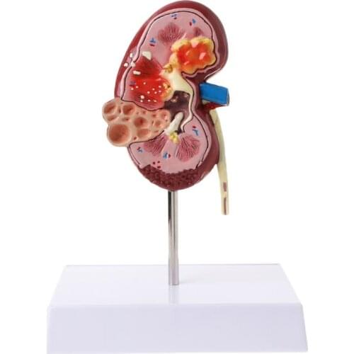 Life Size Human Model Diseased Model Anatomical Anatomy Diseased Pathological Stone Organ Kidney Model Teaching Supplies