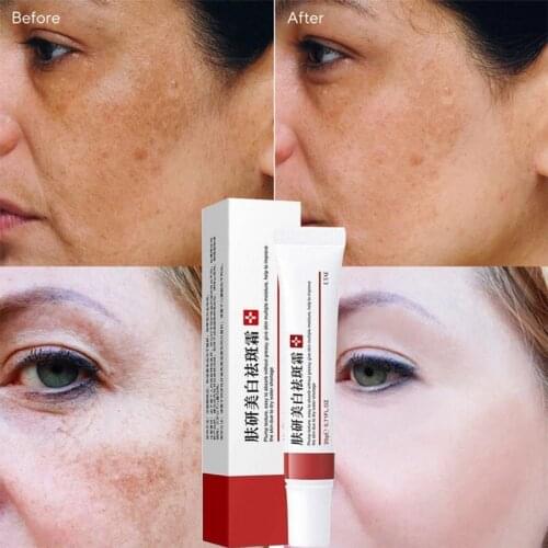 Whitening Cream Remove Spots Acne Improve Dark Yellow Skin Freckle Cream Fade Scars Pigmentation Melasma Brighten Skin Care 20g