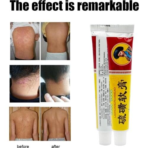 ZB Skin Psoriasis Cream Dermatitis Eczematoid Eczema Ointment And Sulfur Cream