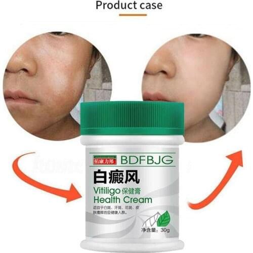 30ml Sumifun Chinese Vitiligo Ointment For Daytime Symptoms On Hands Cream Back Liniment Treatment Neck Of Face M7B0
