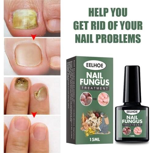 Nail Fungus Treatment / Onychomycosis Paronychia / Anti Fungal Nail Infection Good Result Chinese Herbal Toe Nail Treatment