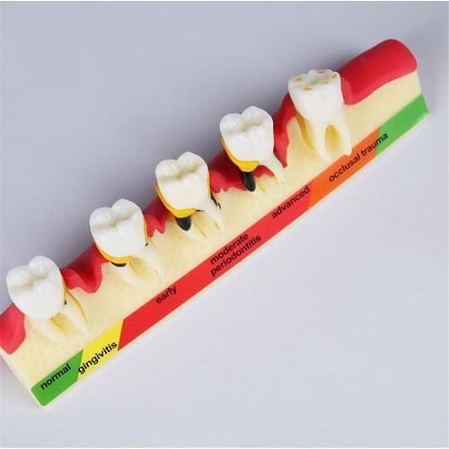 Dentist Use Dental Disease Model M4010 Demonstrates The Progress of Periodontal Disease