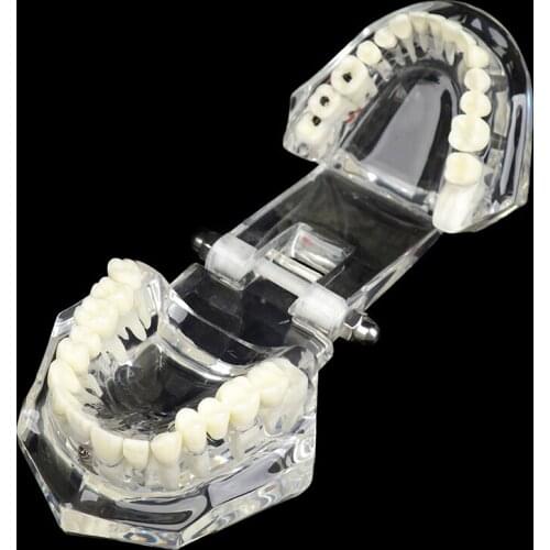 Dental Model Teeth Implant Restoration Bridge Teaching for Study Tooth Science