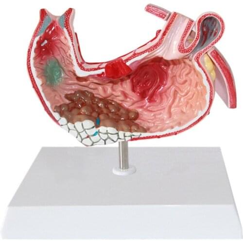 Gastric Disease Demonstration Stomach Pathological Model Anatomy Medical Supplies