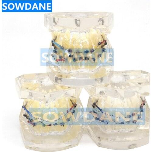 Transparent Dental Orthodontic Mallocclusion Model with Brackets Archwire buccal tube Tooth Extraction for Patient Communication