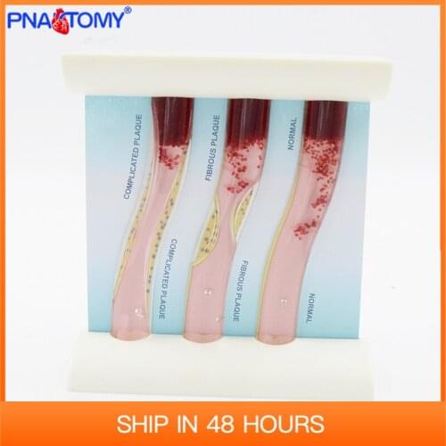 Blood vessel model human arteries hyperlipidemia Medical Teaching Tool Anatomy Educational Equipment Anatomical Blood Cell