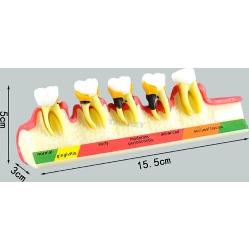 Dental Periodontal Disease Classification Model Demonstration Teach Study Decayed tooth Show Periodontal Disease Progress Model