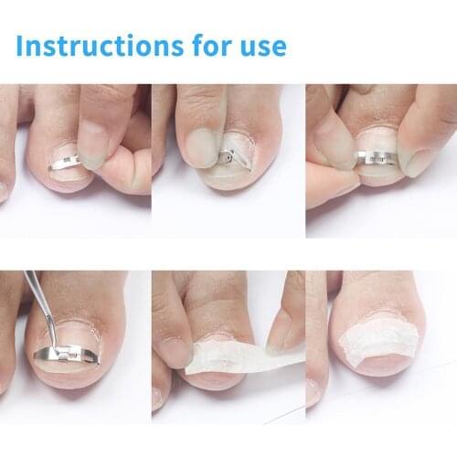 1 Set Ingrown Toe Nail Straightening Clip Wire Fixer Toenail Correction Pedicure Tool Curved Patch Toenail Elastic Patches
