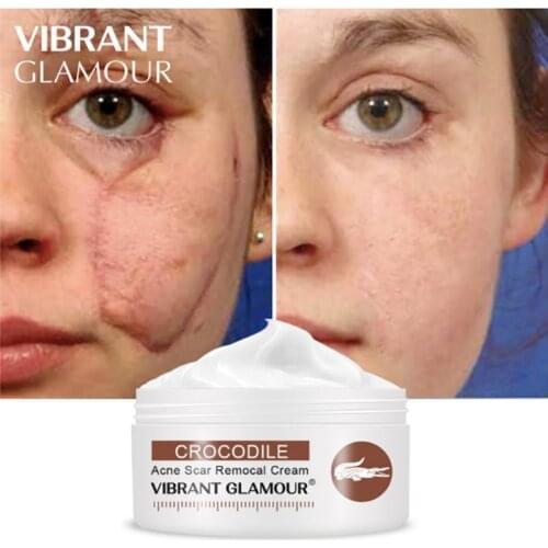 Crocodile Stretch Marks Remover Cream Pregnancy Scars Ance Maternity Repair Creme Para Estrias Body Femme Cicatrices Eliminar