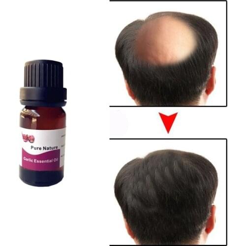 Hot sale Natural Garlic Essential Oil Hair Care For Prevent Hair Loss Hair Root Nutrition Essential Oil For Hair Straightening