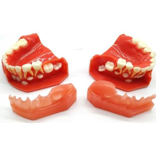 M7012 Mix Dentition Pediatric Development Model Age 5-9 Dental Teeth Model M7012