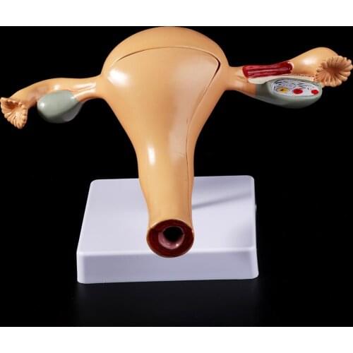 Human Pathological Uterus Ovary Model Anatomical Anatomy Disease Pathology Medical Lesion For Teaching
