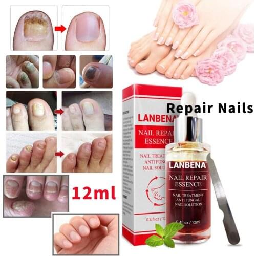 LANBENA Fungal Nail Repair Essence Serum Care Treatment Foot Nail Fungus Removal Gel Anti Infection Paronychia Onychomycosis