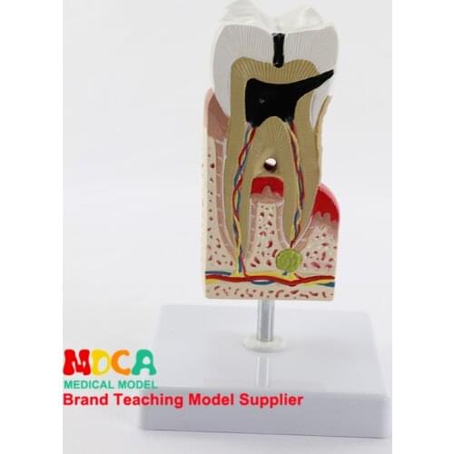 Dental anatomy model, tooth enlargement, tooth decay, gingival display, medical teaching model MYC010
