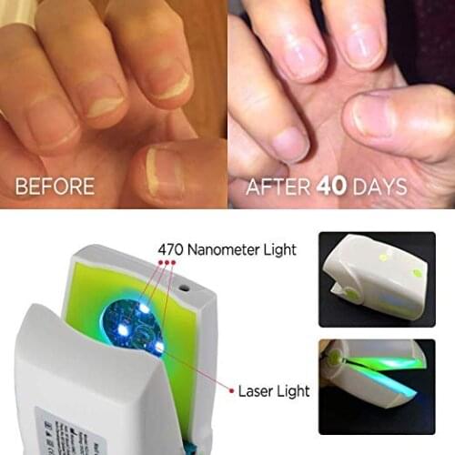 Nail Onychomycosis Treatment Anti Nail Fungal LLLT Physiotherapy Kill ToeNail Fungus low level cold Laser Therapy Device