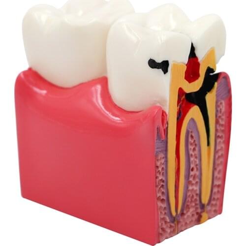 1pc Dental Lab Teeth Model 6 Times Caries Dental Model as Comparation Study Models For Dentist Studying and Researching