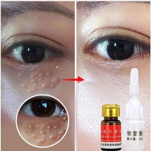 Mole & Skin Tag Removal Solution Painless Mole Skin Dark Spot Removal Face Wart Tag Freckle Removal Cream Oil Plaster