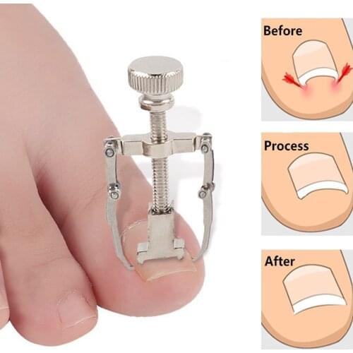Ingrown Toe Pedicure Foot Nail Care Correction Tools File for Feet Orthotic Acronyx Ingrowing Nail Onyxis Bunion Corrector