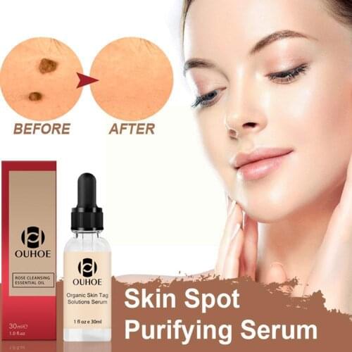 30ml No Trace Painle Skin Tag Remover Serum Mole Removal Wart Painless Mole Face Freckle Cream U2E1
