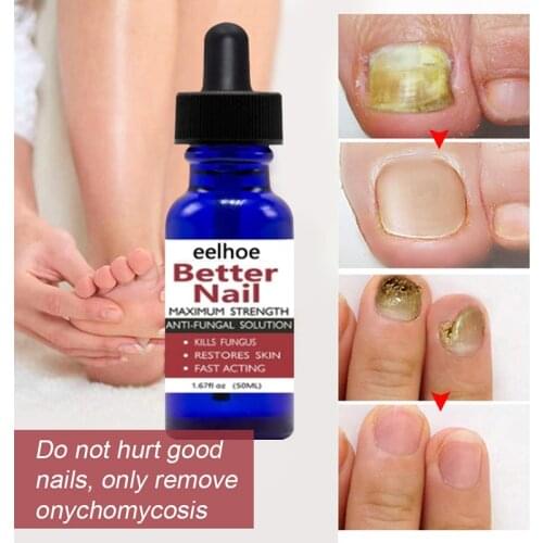 50ml 100% Nail Fungal Treatments Feet Care Essences Serum Toe Nail Fungus Removal Gel Anti Infective Paronychia Onychomycosis
