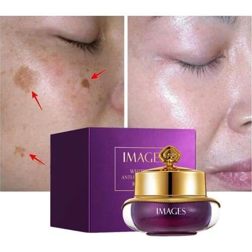 Effective Whitening Freckle Cream Remove Melasma Acne Spot Pigment Melanin Dark Spots Pigmentation Whitening Cream Skin Care