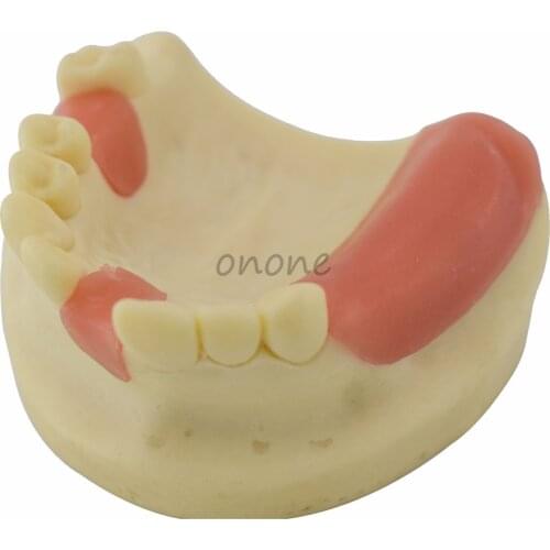 Maxillary Missing Tooth Model Bone Imitating Oral Teaching Aids Dental Implant Placement Exercise Prop