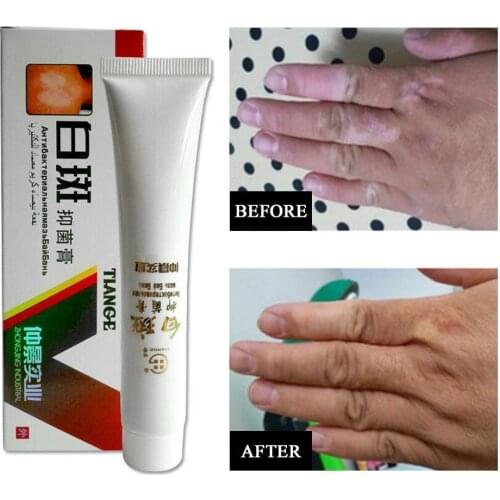 20g White Spot VitiligoTreament Cream Antibacterial Cream Psoriasis Localized Vitiligo Ointment Mycosis Leukoplakia Treatment