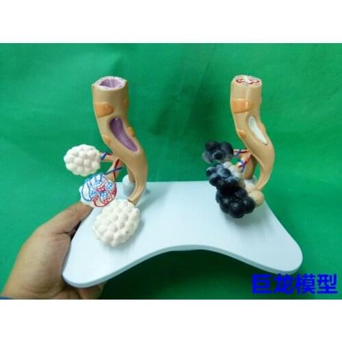 Human Lung Anatomy Diseased Healthy Alveoli Comparison Model Demonstration Teaching Model