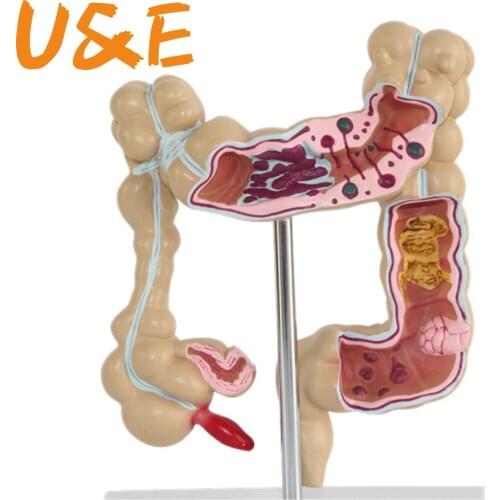 Colorectal lesion model human colon snake large intestine pathological diseases model medical organizer anatomy