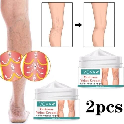2pcs Varicose Veins Cream Red Blood Streak Repair Leg Raised Ointmnet Vasculitis Phlebitis Spider Treatment Body Health Care