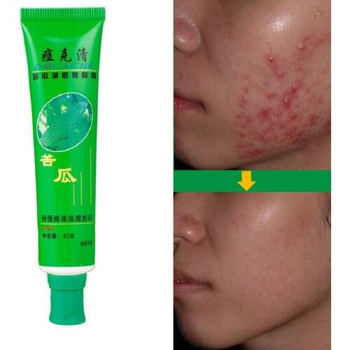 30g Face Removal Acne Cream Pimple Spots Scar Treatment Adult Skin Care Repair