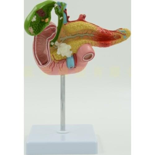 Pancreas, duodenum, and gallbladder pathological model, gallstone surgery, digestive system, hepatobiliary model