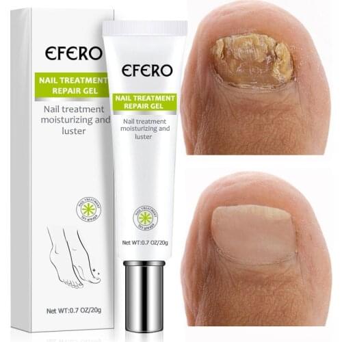 EFERO Anti-Fungal Nail Gel Anti-Infection Nails Treatment Hand Foot Cream Repair Toenail Remove Fungus Nails Essence Product