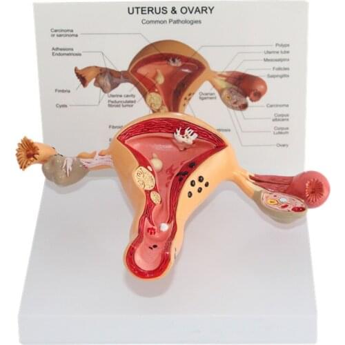Uterine lesion model ovarian uterine pathology female genital anatomy model