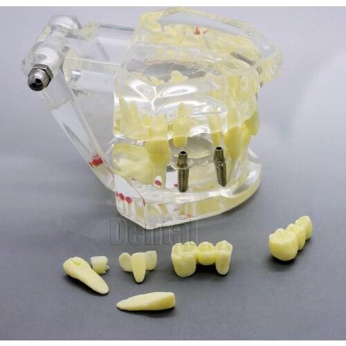 High Quality 2016 Dental implant Demonstration Bracket Simulation Teeth Model teeth removable