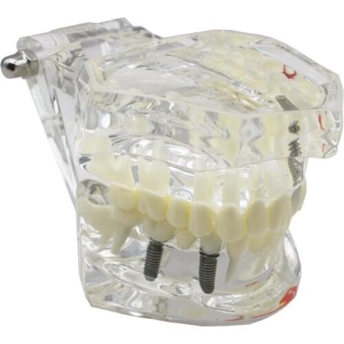 2 pcs Dental Implant Disease Teeth Model With Restoration Bridge Tooth Dentist For Medical Science Dental Disease Teaching Study