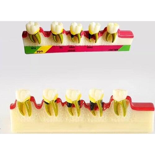 Free Shipping Dental Periodontal Disease Assort Tooth Typodont Model