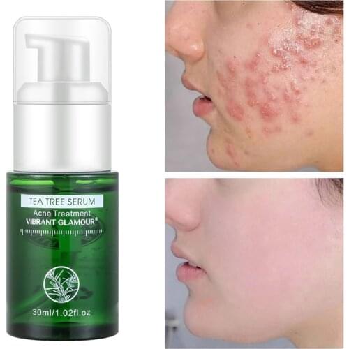 Tea Tree Extract Anti-Acne Face Serum Moisturizing Skin Remove Scars Sooth Skin Shrink Pores Treat Pimple Facial Essence 30ML