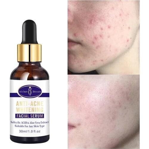 Anti-Acne Whitening Facial Serum Fades Acne Marks Moisturizing Facial Essence Skin Care 30ml