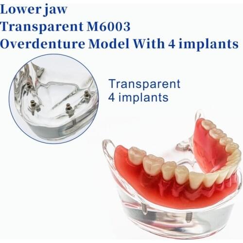 Dental Overdenture Teeth Model Removable Interior Mandibular Lower Teeth Model Mandibular with Implant for Tooth Teaching Study