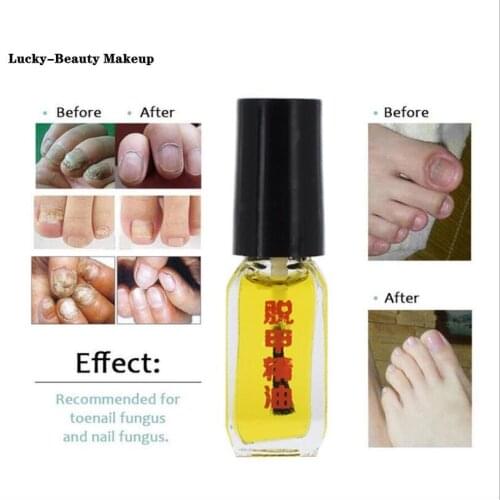 Really work Nail Treatment Removal of onychomycosis Paronychia Anti oil Fungal Nail Infection Toe Nail Fungus Treatment oil