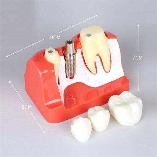 Dental Implant Analysis Crown Bridge Teeth Model M2017R Dental Teeth Model Dentist Patience Model 4 Times Dental Implant Model