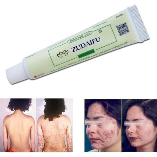 New Cream for Psoriasis ointment for the treatment of Dermatitis, eczematoid ointment for Psoriasis in skin Repair